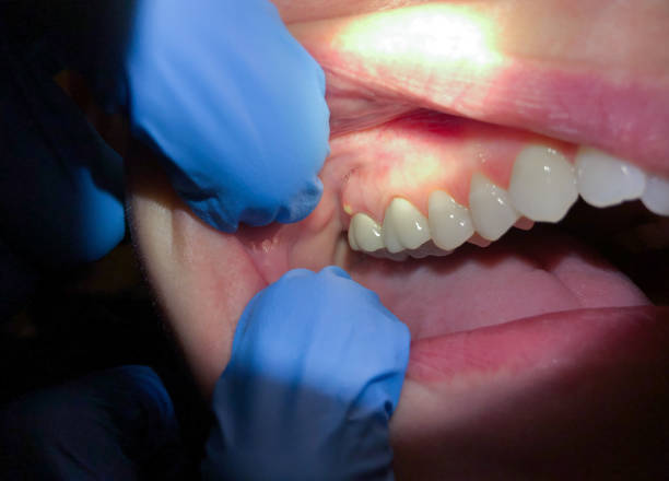 Best Emergency Dental Extractions in St George, MO