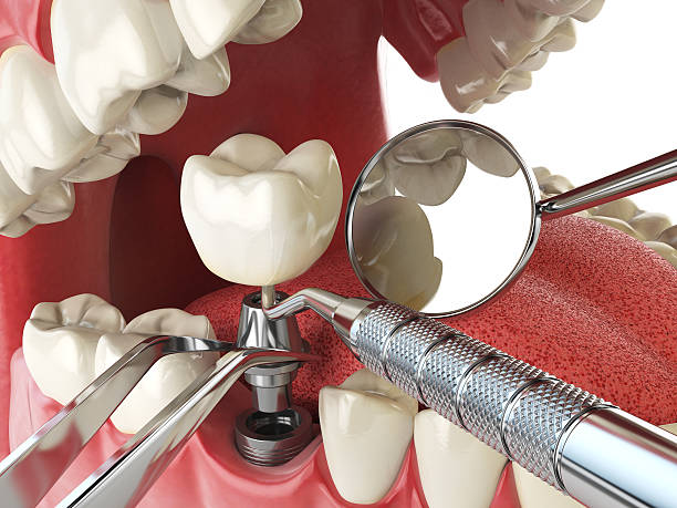 Best Emergency Dental Extractions in St George, MO